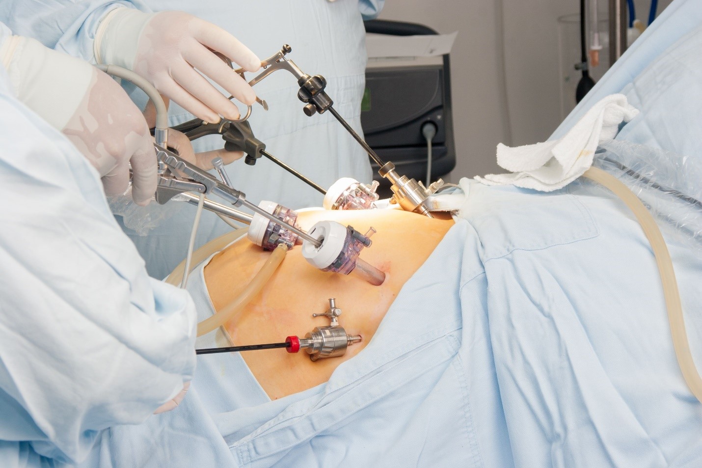 جراحی ساسی بای‌پس معده، یکی از روش‌های نوین جراحی بای‌پس است